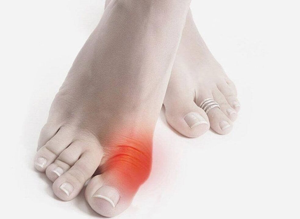 symptômes du pied de la goutte
